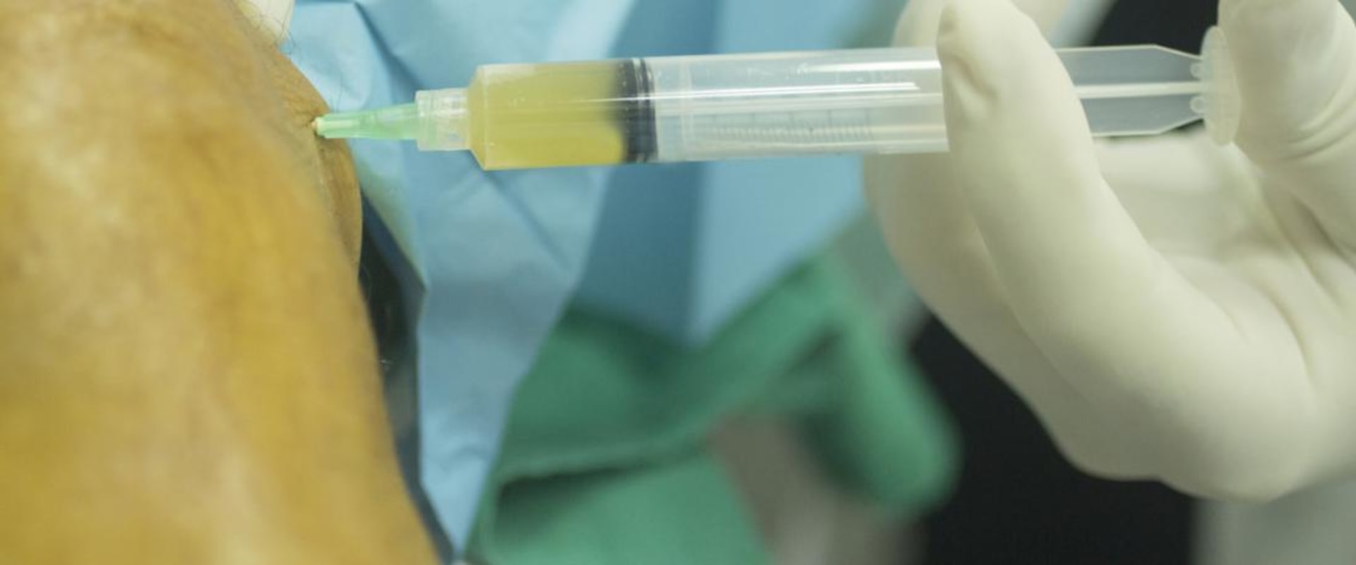 What to Expect After a PRP Injection