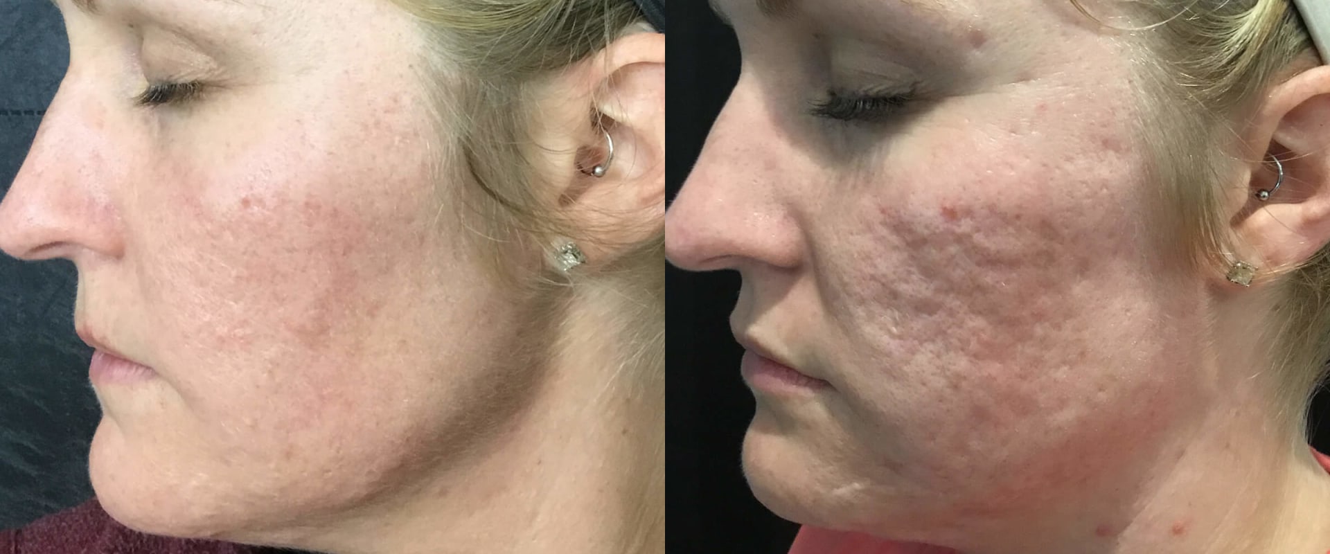 How Long After PRP Injections Can You See Results?