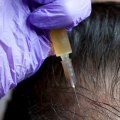 What Are PRP Injections and How Can They Help With Hair Loss Treatments?