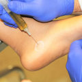 What Does a PRP Injection Feel Like?