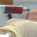 How Long Do PRP Injections Last?